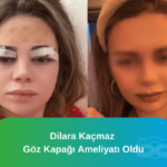 Dilara Kaçmaz Göz kapağı ameliyatı