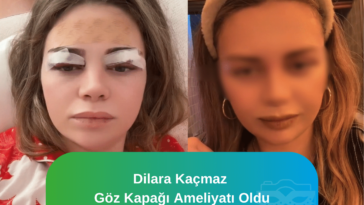 Dilara Kaçmaz Göz kapağı ameliyatı