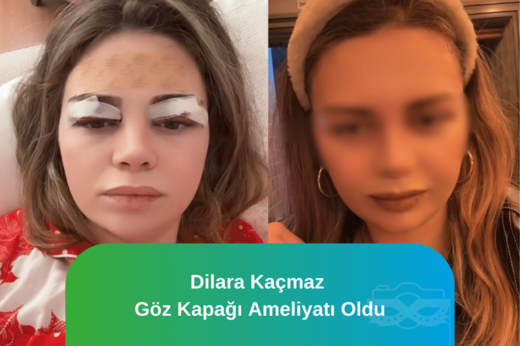 Dilara Kaçmaz Göz kapağı ameliyatı